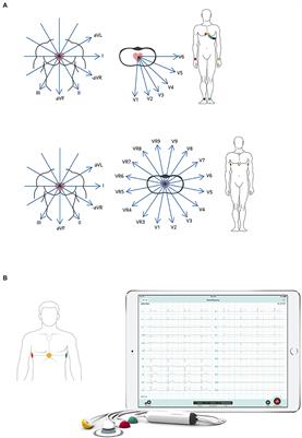 Feasibility of CardioSecur®, a Mobile 4-Electrode/22-Lead ECG Device, in the Prehospital Emergency Setting